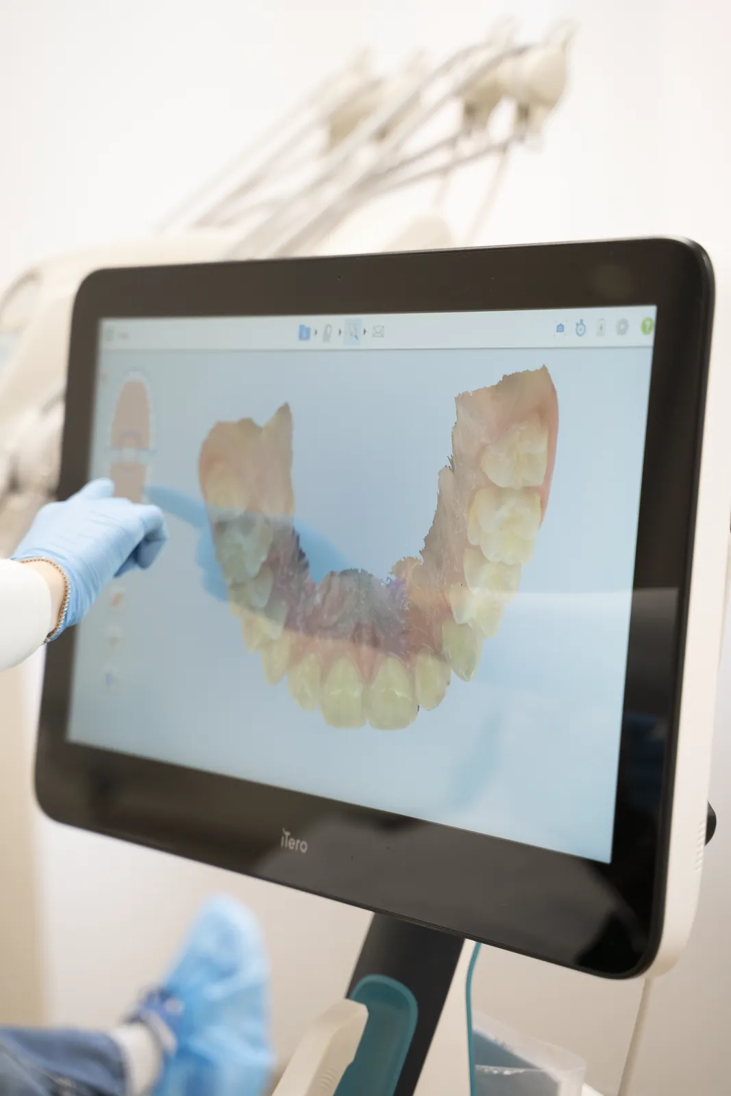 Simulazione digitale del trattamento Invisalign