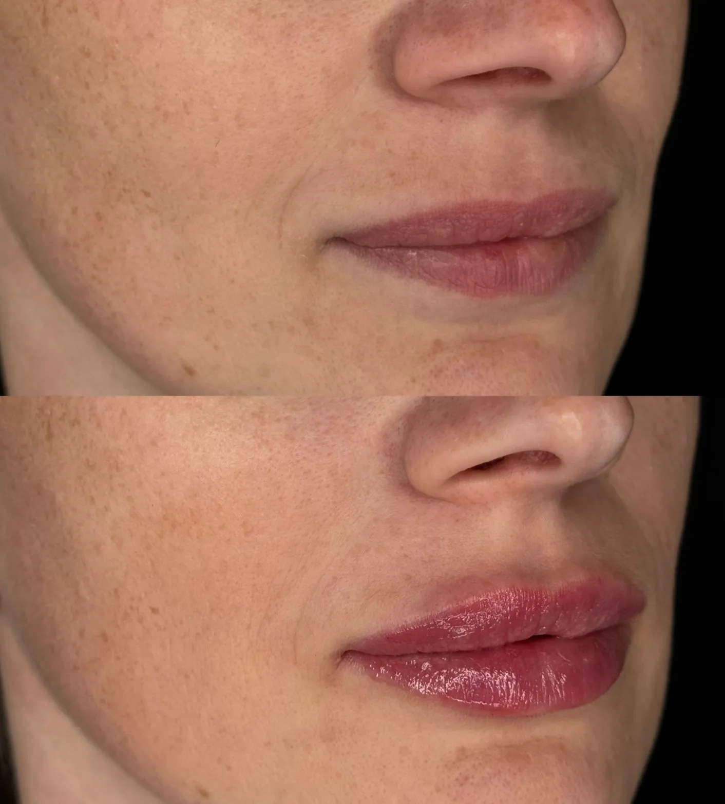 Labbra prima e dopo il trattamento con filler