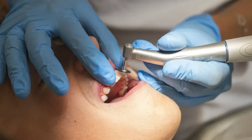 Cura conservativa di un dente