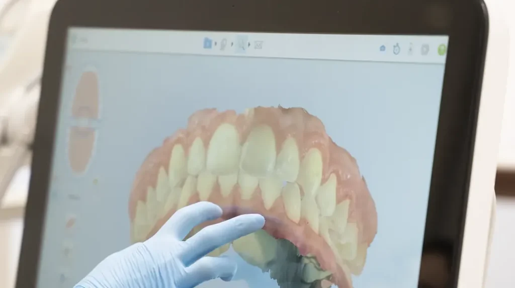 Scansione digitale dell'arcata dentale sul monitor