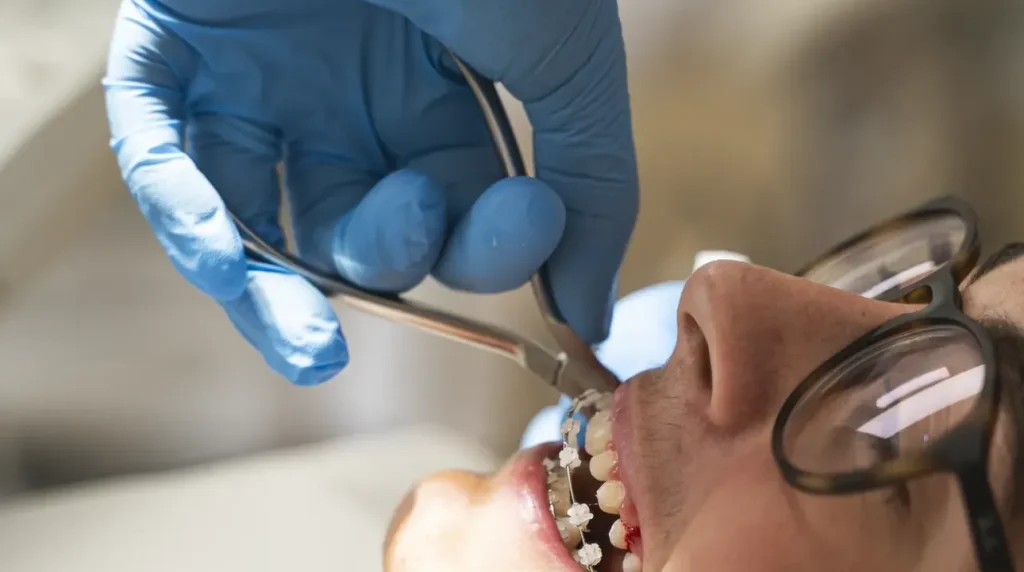 Controllo di un apparecchio ortodontico fisso